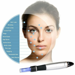 microneedling