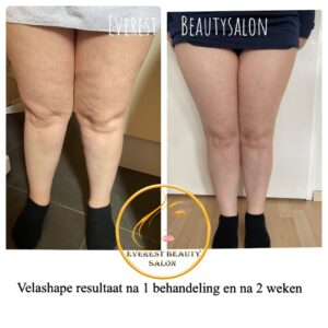 velashape-body