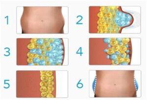 cryolipolyse